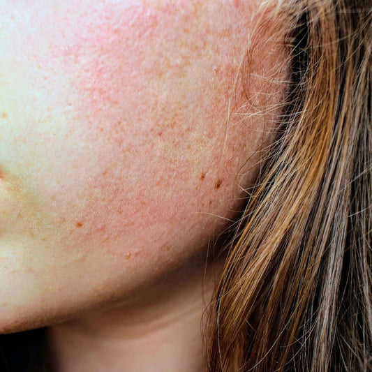 Luffa-Peeling bei unreiner Haut & Akne: Was wirklich hilft — und was du vermeiden solltest